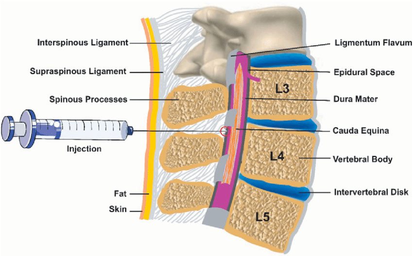 Medical illustration showing epidural injection placement in the lumbar spine